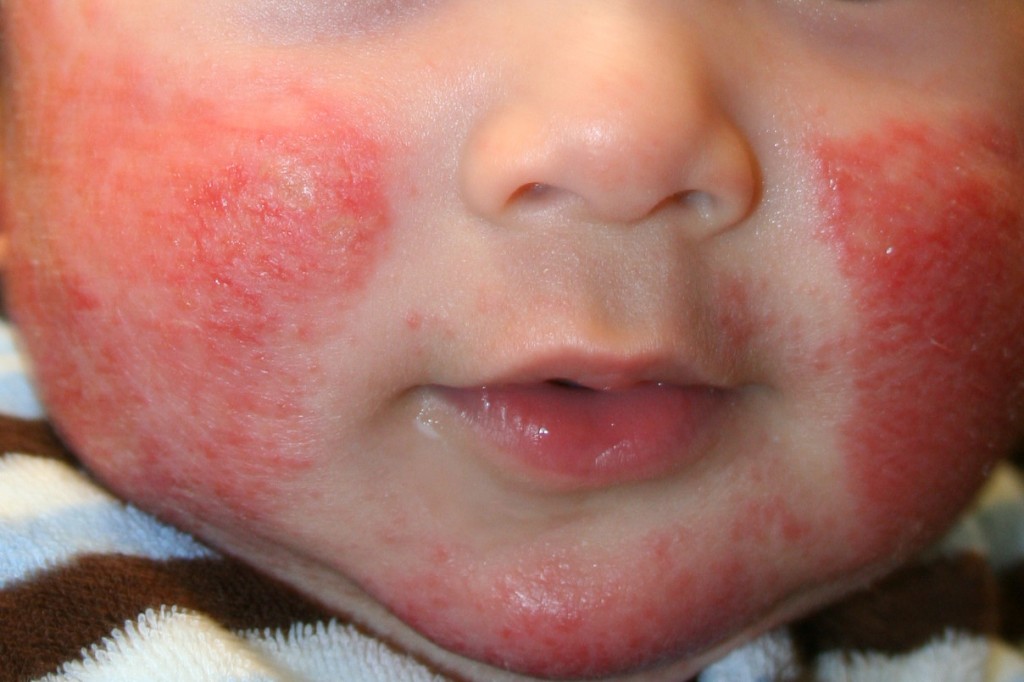 En los niños la dermatitis atómica aparece con mayor frecuencia en la región facial